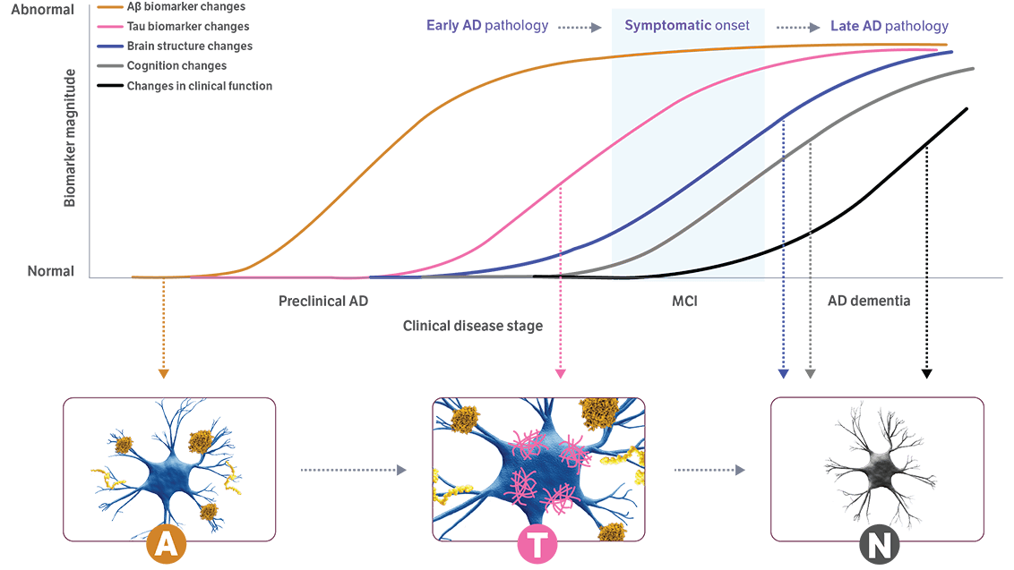 Timeline showing amyloid and tau biomarker buildup years before Alzheimer’s symptoms appear.